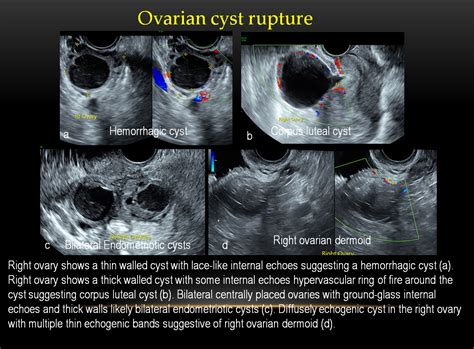 diagnostic test for ovarian torsion|twisted or ruptured ovarian cyst.